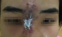 Nữ sinh viên 19 tuổi hoại tử mũi vì tiêm chất làm đầy