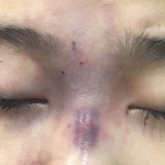 Chồng tiêm filler làm mù mắt vợ