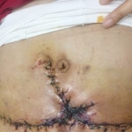 Hoại tử nặng vì hút mỡ bụng giảm béo