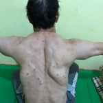 Uống rượu nhiều năm, 3 người đàn ông mắc bệnh lạ, khối u khủng mọc chi chít