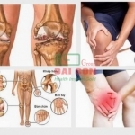 1001 căn bệnh về xương khớp