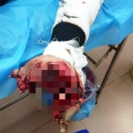 Dùng điện thoại khi đang sạc, nam thanh niên bị nổ tung bàn tay