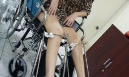 Kéo chân ở Việt Nam: có thể kéo dài tận 20cm?