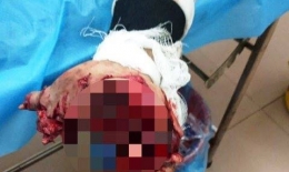 Dùng điện thoại khi đang sạc, nam thanh niên bị nổ tung bàn tay